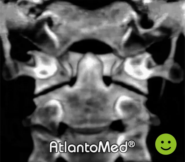 TC-spirale Atlante e Epistrofeo prima e dopo il riallineamento dell'Atlante