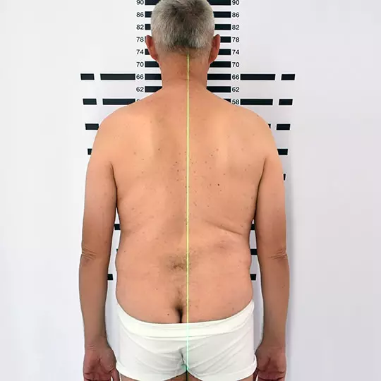 alluce valgo cosa fare?