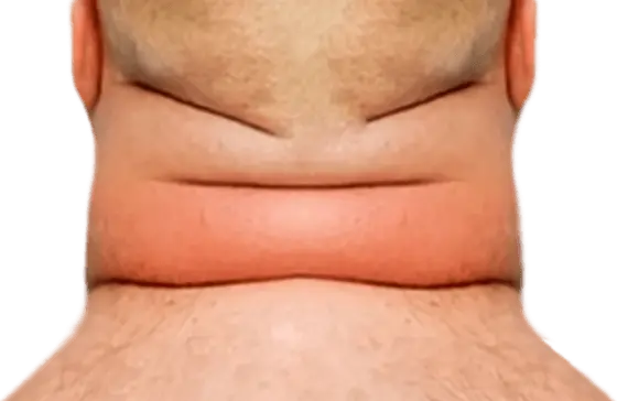 Collo taurino Collo taurino